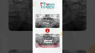 Full Mouth Dental Implants | Reface Dental Meerut | Dr. Gaurav Dhaka