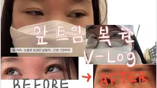 앞트임 복원 2달 / 2달경과 / 실밥제거 / 직장인 성형 /