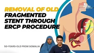Successful Removal of Old Fragmented Stent through Latest & Advanced ERCP Procedure