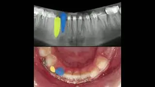 ارتودنسی دندان نیش نهفته | Guided eruption of impacted canine