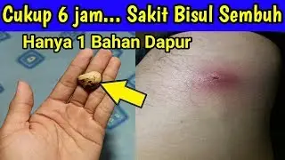 Obat Bisul Paling Ampuh, Cara Mengobati Bisul Secara Alami