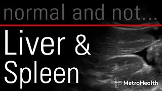 Liver & Spleen: Normal and Not