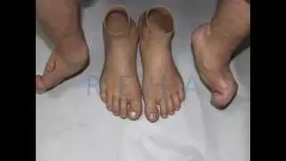 Ön Ayak Protezi / Forefoot Prosthesis ( Chopart Pirogoff Lisfranc )