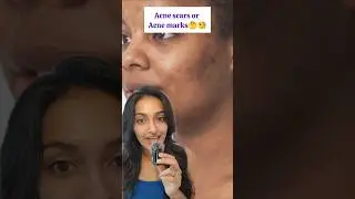 Acne scars or Acne Marks??? Well let's findout #skincare #acne #marks #scars #acnetreatment #acne