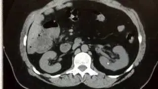 CT urogram with many stones!