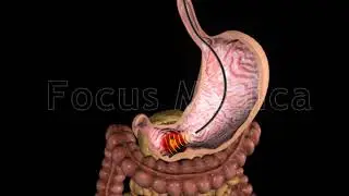TNM staging of gastric cancer - Animated Atlas of Breast and Gastric Cancer