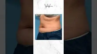 CoolSculpting Before & After Results