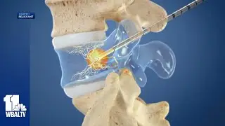 New, minimally invasive procedure in Baltimore treats back pain