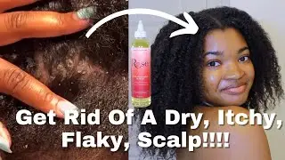 HOT OIL TREATMENT for Dry, Itchy, Flaky Scalp!!! | ft. A Naturale Rose Soothe & Strengthen Oil Blend