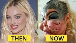 Top 5 Hollywood Plastic Surgery Fails That Ruined Careers  Then & Now 2025