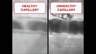 Healthy and Unhealthy Capillary Side-by-Side Comparison