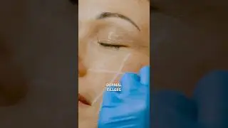 Dermal Fillers for Natural Volume & Smooth Skin! #dermalfillers #fillers #botox #antiagingsolution