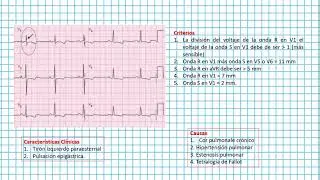 Hipertrofia ventricular derecha ( Clases EKG #28)