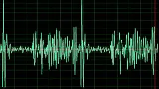 Mitral Stenosis- normal speed