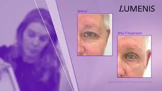 Lumenis - OptiLIFT