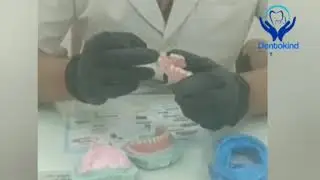 Nicholas Diethelm - #flexibledenture #overdenture #nesbit #implantdenture #partialdentures