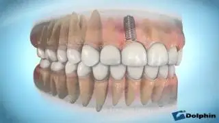 Seattle Dental Implants