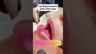 Our advanced CO2 Laser Lip Rejuvenation treatment smooths, revitalizes, and Your natural beauty