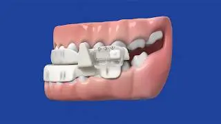 SleepRight Snore Aid - How it Works