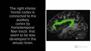 Cortical Thickness in Congenital Amusia  When Less Is Better-Part 2