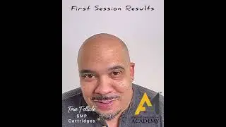 Client's first session Scalp Micropigmentation testimonial