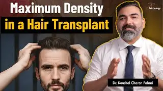 Thin Hair After Hair Transplant? Here&rsquo;s What Went Wrong | Dr. Kaushal Charan Pahari | SB Trichology