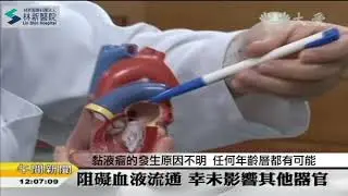 黎方中心臟黏液瘤