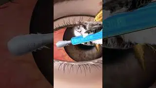 [ASMR] Eye mucus removal animation conjunctivitis treatment animation asmr /눈곱제거 , 결막염 치료 애니메이션