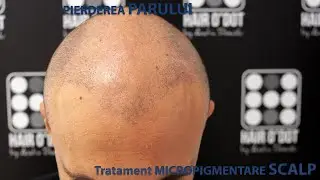 Pierderea parului tratament Micropigmentare Scalp