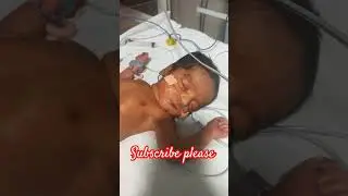 treatment of newborn baby in NICU #Newborn #treatment #nicu