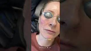 IPL Laser (Intense Pulsed Light) for Redness, Hyperpigmentation and Sun Damaged Skin | Dr. Parsa