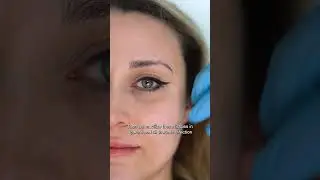 The Secret to Brighter Eyes: Almond Eye (Temporal Lifting) Explained #almondeye #browlift