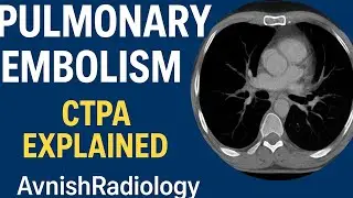 &laquo;ТЭЛА при КТ-ангиографии | Простое руководство по рентгенологии | @Philips @avnishradiology
