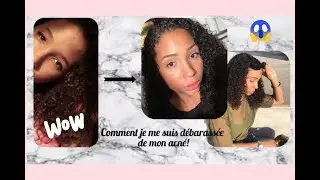 COMMENT JE ME SUIS D&Eacute;BARRASS&Eacute;E DE MON ACN&Eacute; ! 😱 (Roaccutane, mon exp&eacute;rience, mon &eacute;volution )PARTIE 1