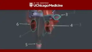 Animation of a Total Heart Transplant
