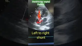 VSD (ventricular septal defect) in Echo, left to right shunt #youtubeshorts #shortsvideo #shorts