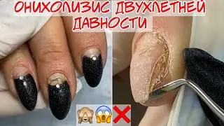 Онихолизис ногтей двухлетней давности 😱❌
