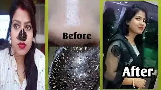 Blackheads को permentaly कैसे  हटायें।।How to get rid of blackheads.