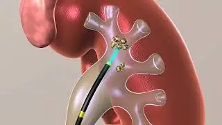 Kidney Stone Removing