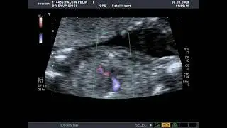 #RIGHT DUCTAL ARCH + #RIGHT AORTIC ARCH  (#FETAL ECHOCARDİOGRAPHY) (TOSHIBA APLIO-80 2009)