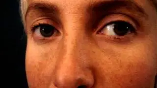 rhinoplastie avant apres chez une jeune femme,operation par vladimir mitz.wmv