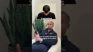 Post-FUE Hair Transplant Recovery Timeline (With Photos)