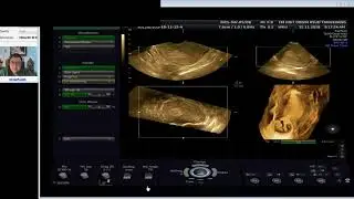 KEHAMILAN CORNU UTERUS (Dr Wiku Andonotopo)