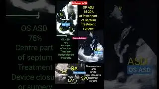 Different types of ASD ( Atrial septal defect) Echo #asd #echo #shorts