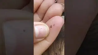 Activities to eliminate large lice on the human