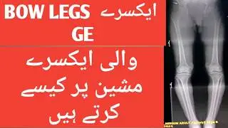 How to perform scanogram of lower limb or how to do X-ray bow legs