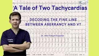28: A Tale of Two Tachycardias: Decoding the Fine Line Between Aberrancy and VT