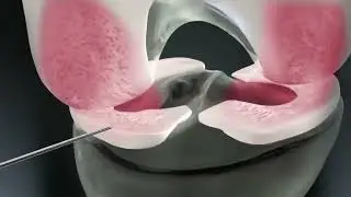 MONOVISC&reg; - Innovative Einzelinjektionstherapie zur Behandlung von Arthrose-Schmerzen