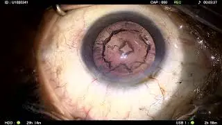 Live Cataract Surgery with FineVision Trifocal IOL &ndash; Dr. Gaurav Luthra