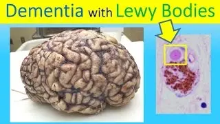 Robin Williams killer:  Dementia with Lewy Bodies [Human Brain] + Alzheimer's & Parkinson's Disease